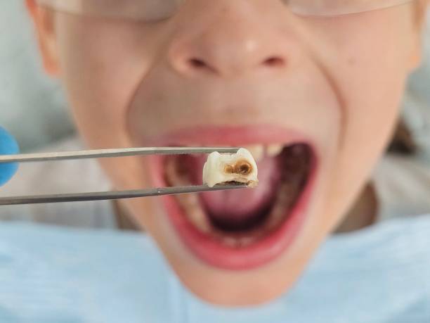 Best Emergency Tooth Extraction in Elsmere, KY